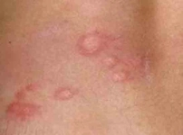 Fiziksel Ürtiker Belirtileri ve Tedavisi