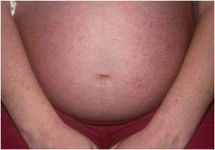 Hamilelikte Ürtiker Belirtileri ve Tedavisi