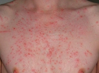 Ürtiker Nasıl Geçer?